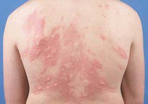 Bệnh mề đay có đặc điểm nhận dạng như thế nào?
