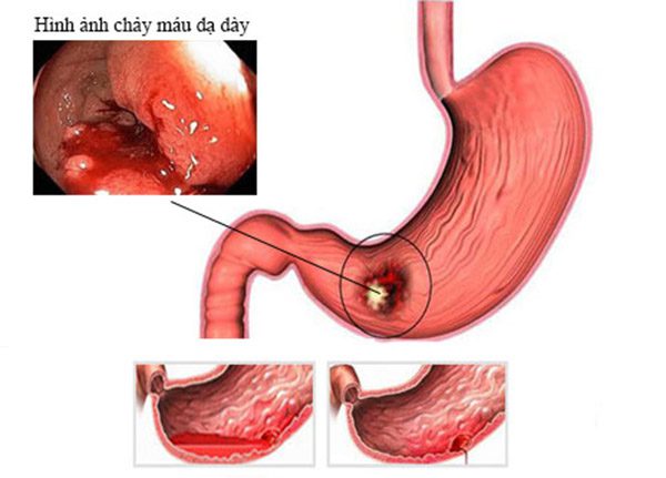 Cùng chuyên gia Điều dưỡng tìm hiểu bệnh chảy máu dạ dày