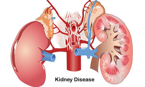 Tìm hiểu biểu hiện và biến chứng của bệnh viêm bể thận cấp tính