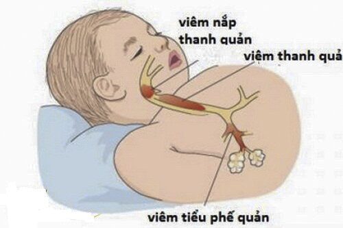 Chứng viêm tiểu phế quản ở trẻ có dấu hiệu bệnh như thế nào?