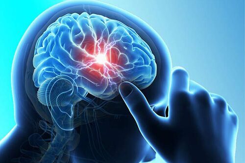 Chuyên gia Điều dưỡng tư vấn về bệnh xuất huyết não