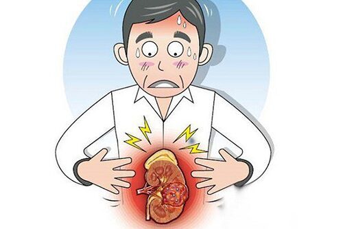 Chuyên gia Y Dược Hà Nội cùng tìm hiểu bệnh ung thư thận