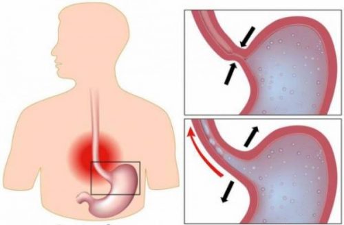 Co thắt thực quản là bệnh gì và có triệu chứng báo hiệu như thế nào?