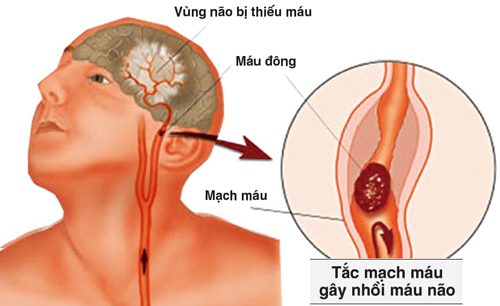 Cao huyết áp xuất huyết gây chết não và tử vong