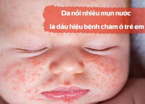 da ne1bb95i nhie1bb81u me1bba5n nc6b0e1bb9bc lc3a0 me1bb99t trong nhe1bbafng de1baa5u hie1bb87u c491ie1bb83n hc3acnh nhe1baa5t ce1bba7a be1bb87nh chc3a0m e1bb9f tre1babb em 2