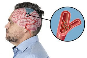 Dược sĩ Hà nội cảnh báo sự nguy hiểm của bệnh đột quỵ