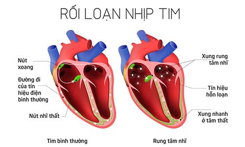 Dấu hiệu cho thấy rối loạn nhịp tim là như thế nào