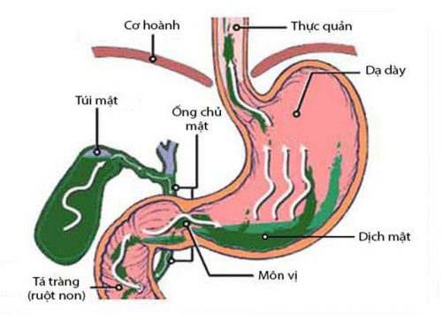 Triệu chứng của trào ngược dịch mật có biểu hiện như thế nào?