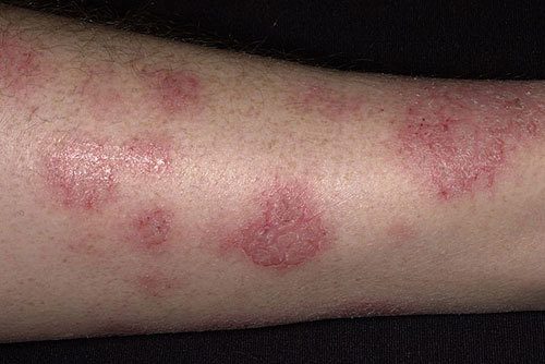 Nguyên nhân gây bệnh chàm là gì?