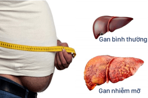 Người bệnh gan nhiễm mỡ nên ăn gì?