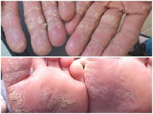 Điều trị bệnh á sừng như thế nào?       