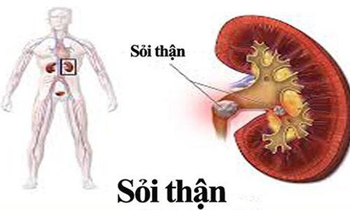 Mách bạn một số mẹo từ tự nhiên đánh tan sỏi thận hiệu quả