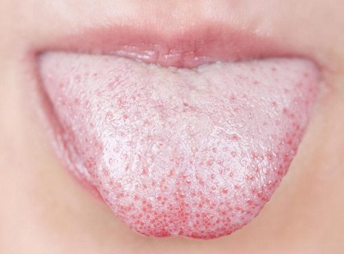 Phương pháp điều trị bệnh nấm miệng