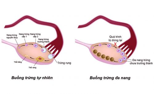 Biểu hiện của hội chứng buồng trứng đa nang
