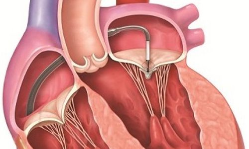 Những lưu ý cần biết sau khi phẫu thuật thay van tim là gì?