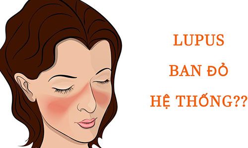 Những nguy hiểm từ biến chứng của bệnh Lupus ban đỏ hệ thống