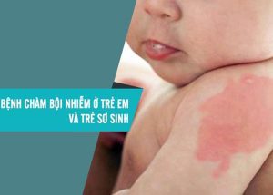 Những yếu tố nào làm tăng nguy cơ bệnh chàm bội nhiễm ?