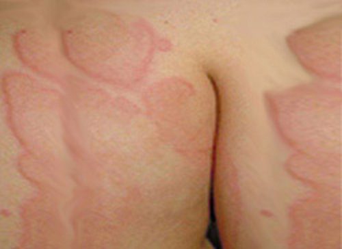 Bệnh mề đay điều trị như thế nào?