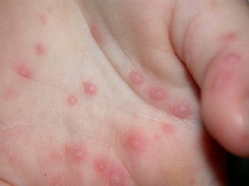 Phương pháp điều trị bệnh ghẻ