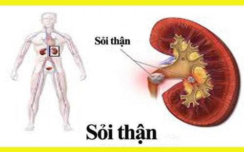 Nguyên nhân và triệu chứng của bệnh sỏi thận là gì?