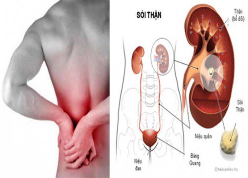 Phương pháp phòng ngừa và điều trị bệnh sỏi thận