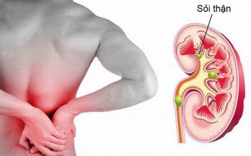 Các triệu chứng và nguyên nhân hình thành sỏi thận