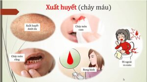 Dấu hiệu bệnh sốt xuất huyết