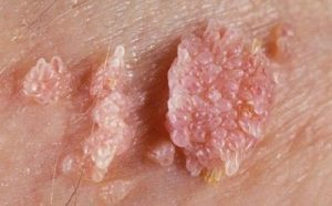 Một số dấu hiệu của bệnh sùi mào gà