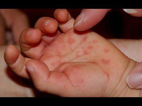 Chẩn đoán phân biệt bệnh tổ đỉa như thế nào?