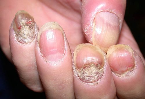 Móng tay bị nhiễm khuẩn do thói quen cắn móng tay