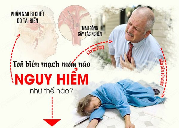 Tai biến mạch máu não nỗi ám ảnh của mọi người, mọi nhà