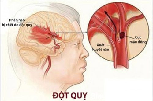 Dấu hiệu nhận biết và phòng tránh bệnh tai biến mạch máu não