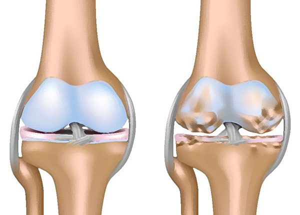 Tác dụng của quả đậu bắp và điều trị bệnh khô khớp không?