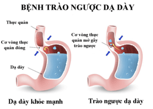 Tìm hiểu tác hại của chứng bệnh trào ngược dạ dày thực quản