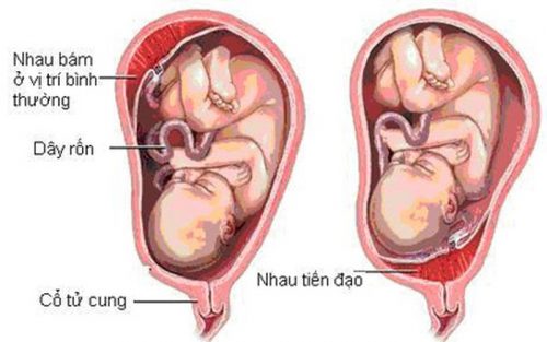 Chăm sóc thai phụ mắc rau tiền đạo như thế nào?