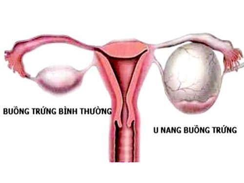 Những lý do gây ra u nang buồng trứng