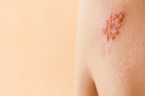 Điều trị Zona như thế nào để không có biến chứng?