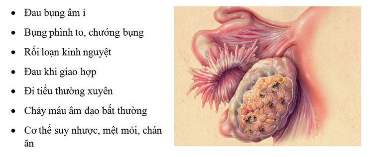 Triệu chứng có thể nhận biết sớm u nang cổ tử cung