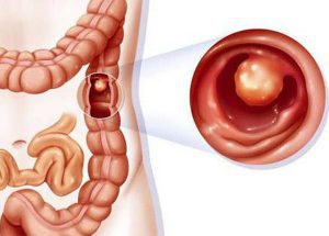 Ung thư đại tràng trái có phương pháp điều trị nào ?