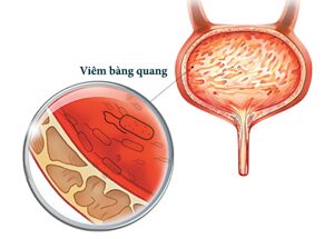 Viêm bàng quang là gì, có thể phòng tránh bệnh như thế nào ?