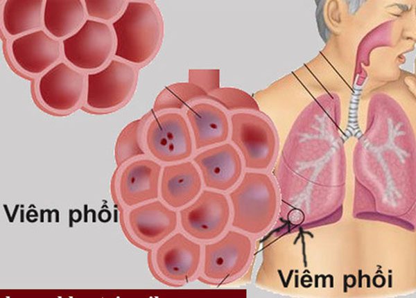 Viêm phổi là một trong những bệnh lý gây ho kéo dài