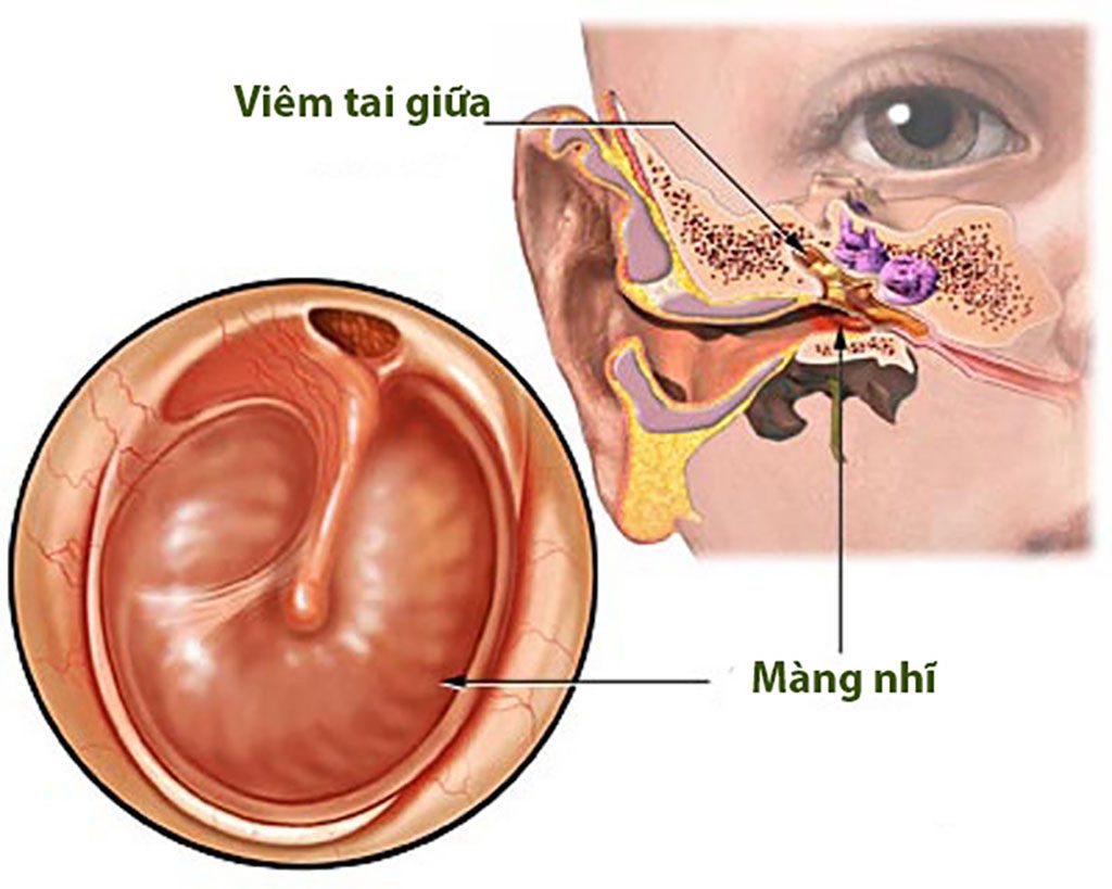 viem tai giua taimuihongsg 1
