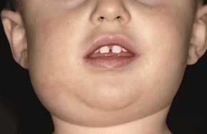 Viêm tuyến nước bọt dưới hàm trái làm một vùng bị sưng tấy