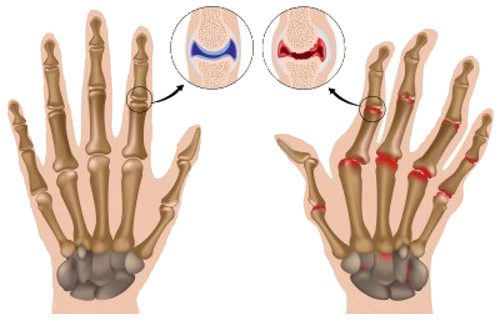 Tay phải thường dễ bại thoái hóa khớp hơn so với tay trái