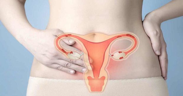 Đối tượng bị béo phì, bị thừa cân cũng có nguy cơ mắc nội mạc tử cung