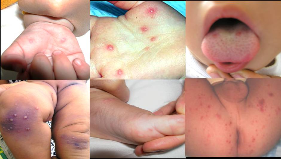 Một số dấu hiệu chân tay miệng thường gặp