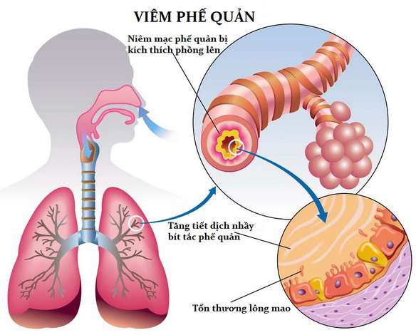 viem-phe-quan-o-tre-em-kha-pho-bien