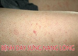 bE1BB87nh dC3A0y sE1BBABng nang lC3B4ng