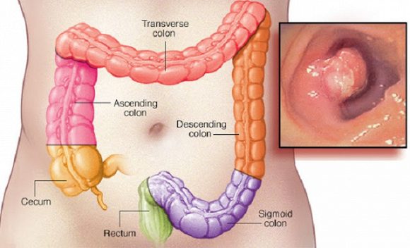 Bệnh ung thư hậu môn có chữa được không?