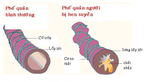Những thực phẩm làm dịu cơn hen suyễn